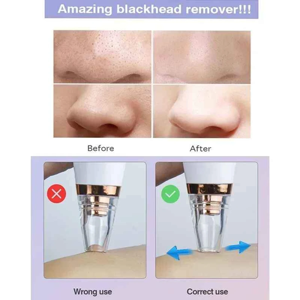 blackhead Remover - Image 3